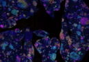 Australian study identifies early blood marker for lung cancer risk