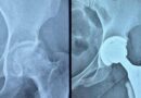 Gujarat: Ahmedabad Civil Hospital performs high-risk hip replacement on woman with serious blood disorder