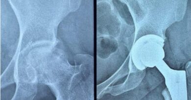 Gujarat: Ahmedabad Civil Hospital performs high-risk hip replacement on woman with serious blood disorder