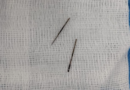 Gujarat: 12-year-old swallows metal pin; AIIMS Rajkot doctors remove it without surgery