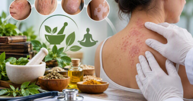 Govt unveils standard treatment protocols for dermatological disorders